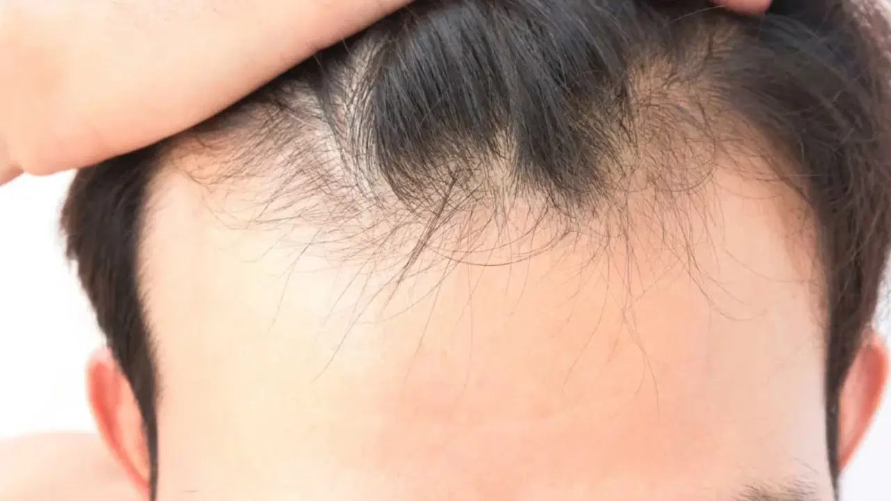 Saç dökülmesinde gizli neden: Vitamin ve mineral eksikliği ne kadar etkili?